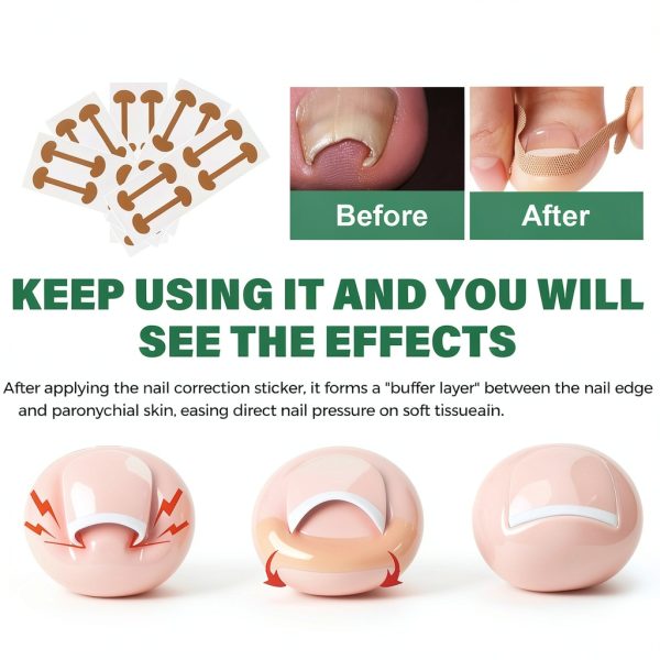 Ingrown Nail Kit Yutlei Professional Tool-3