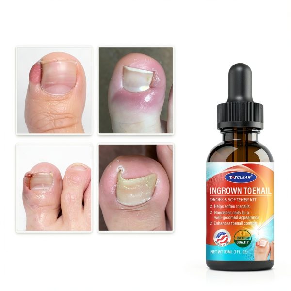 Ingrown Toenail Solution by TOTCLEAR Gentle Nail Care-1