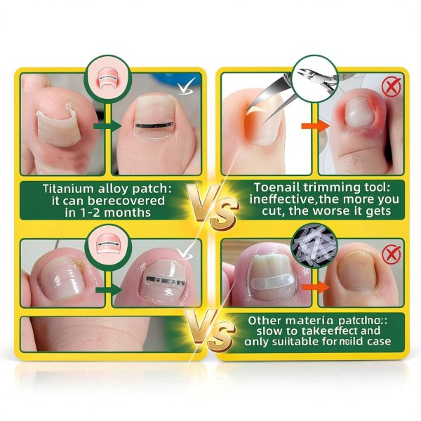 Ingrown Toenail Corrector Fuzzycare Memory Patch-3